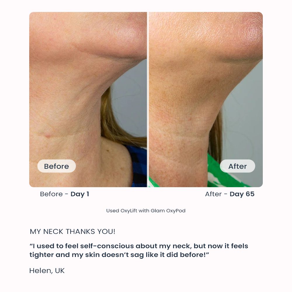oarno oxylift helen testimonial gallery 1