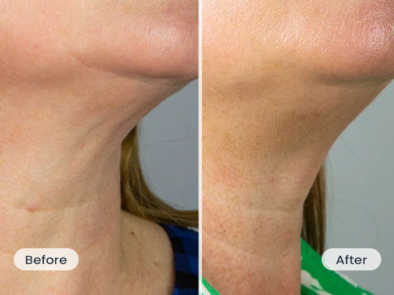 oarno oxylift testimonial helen